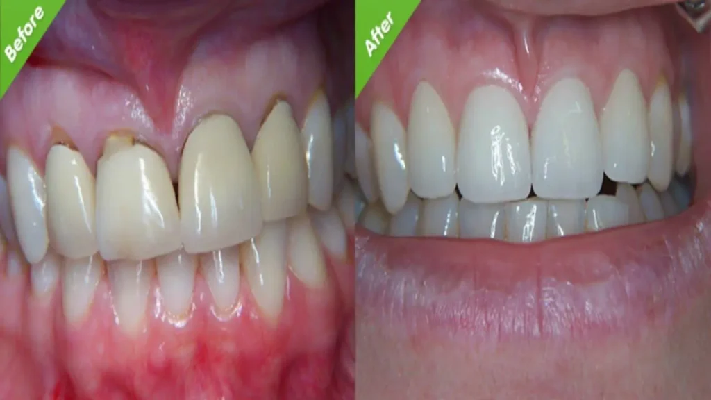 after root canal treatment 
